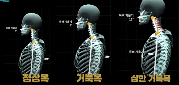 목디스크의 원인